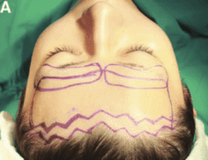 zigzag hairline lowering incision; straight hairline